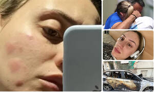 Άννα Κορακάκη: Συγκλονιστική κατάθεση ψυχής - Τα τραύματα που της άφησε εμμονικός «θαυμαστής» (pics)